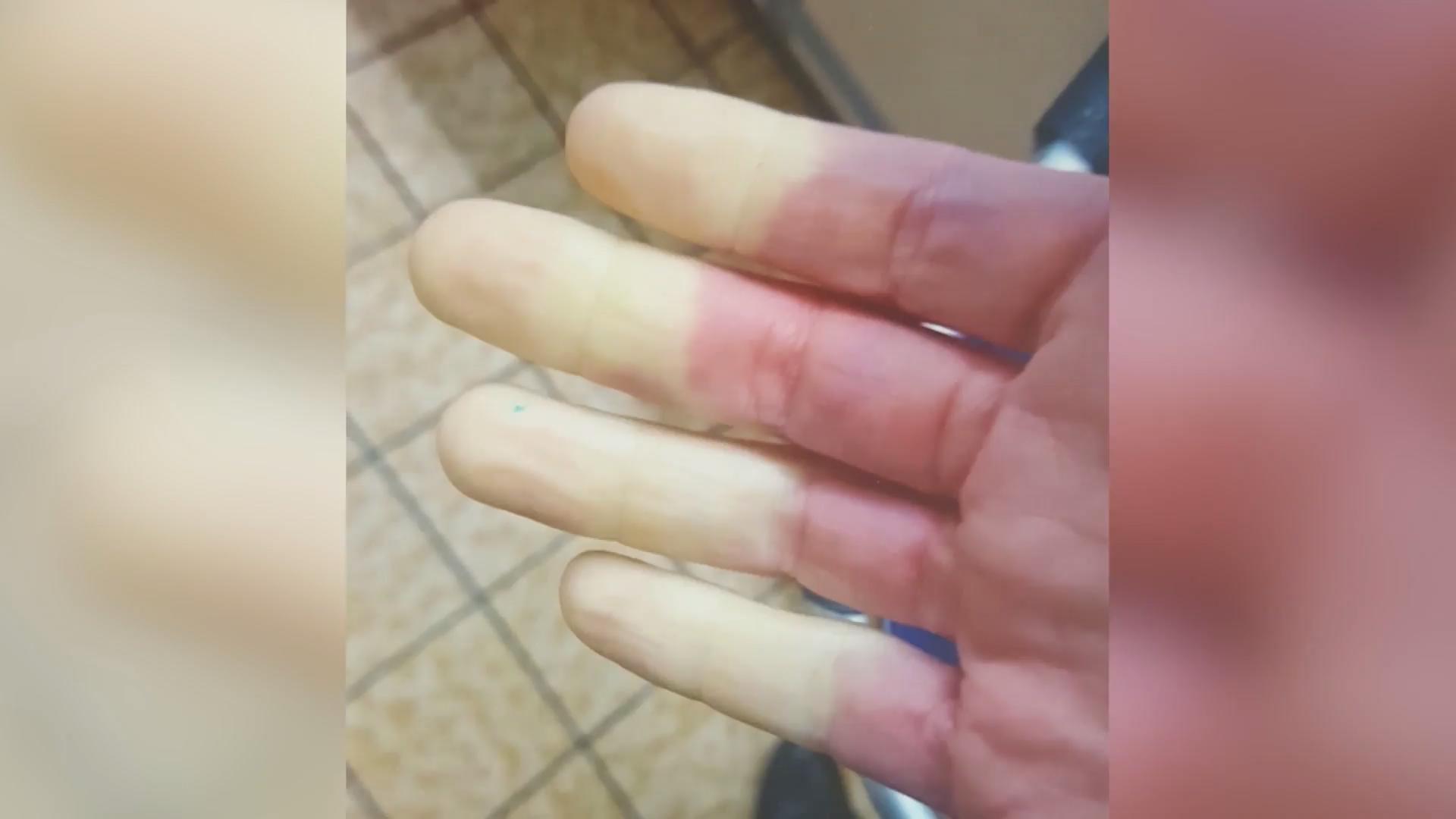 Wenn Die Finger Bei Kalte Taub Werden So Schmerzhaft Ist Das Raynaud Syndrom