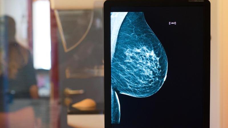 Mammographie-Screening zeigt gesunde Brust