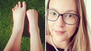 Victoria Curthoys: Links ihre Füße nach der Amputation, rechts die junge Australierin selbst