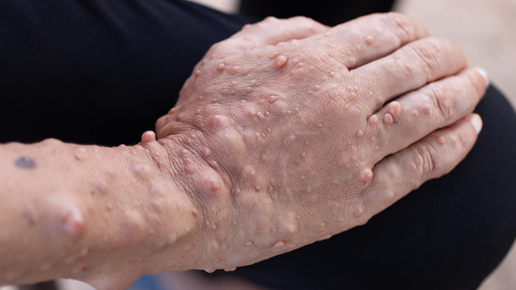 Symptom von Neurofibromatose: Eine Hand mit vielen kleinen Geschwülsten unter der Haut