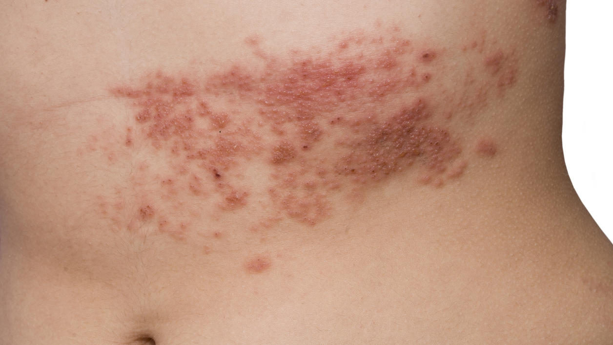 Typischer Hautausschlag bei einer Gürtelrose (Herpes zoster)