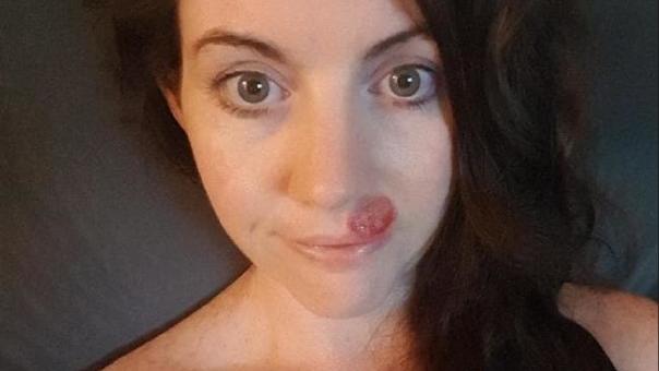 Jessica Pasco dachte zuerst, sie hätte nur einen harmlosen Pickel im Gesicht - doch die rote Stelle entpuppte sich als Hautkrebs.