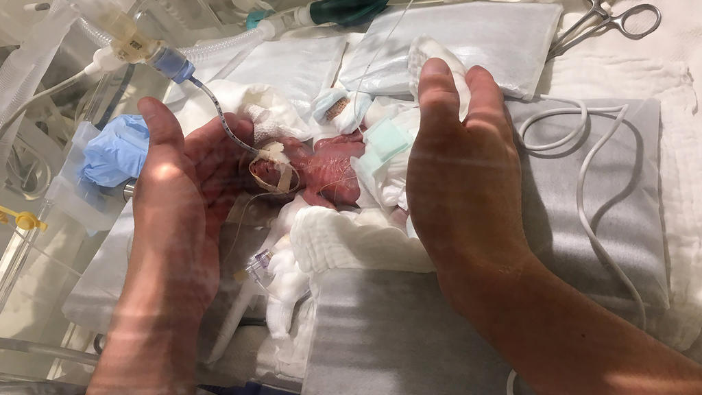 Der kleine Junge kam in der 24. Schwangerschaftswoche per Kaiserschnitt auf die Welt.
