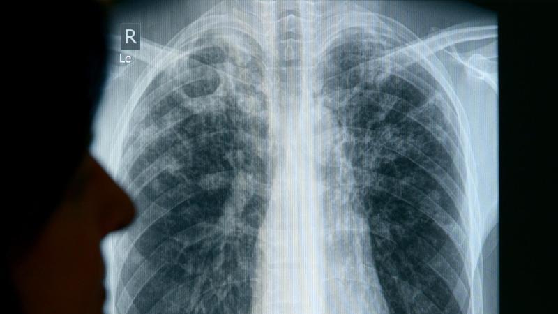 Die Röntgenaufnahme eines erkrankten Patienten.