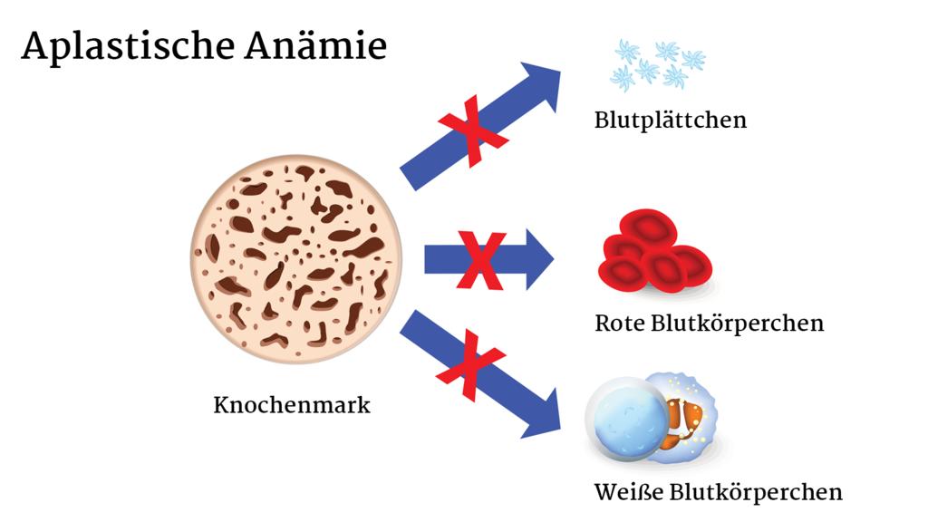 Illustration der Aplastischen Anämie