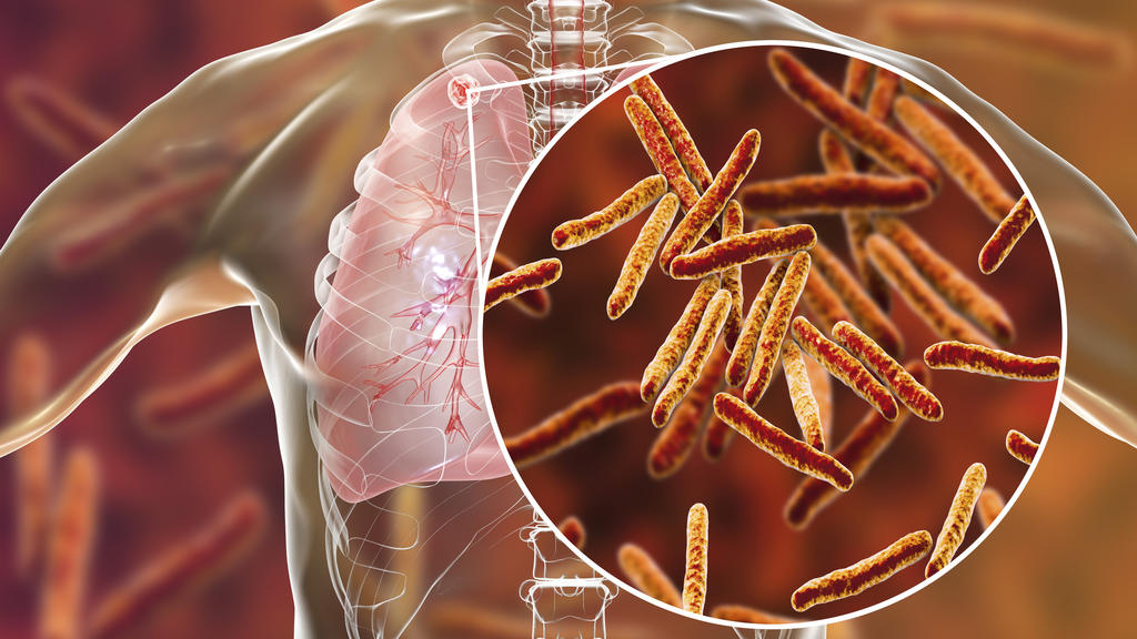 Mycobacterium-Tuberkulose-Bakterien in der Lunge