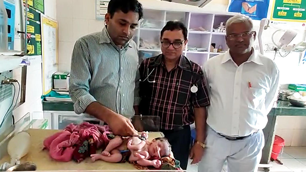 Die Ärzte in Indien hoffen, dass sie die überflüssigen Gliedmaßen von dem Mädchen trennen können.