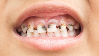 Karies in Zähnen