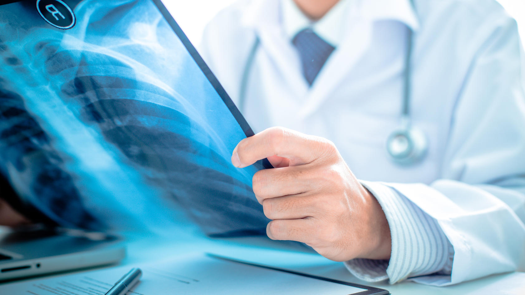 Ein klassisches Röntgenbild ist bei der Diagnose von Lungenkrebs nicht immer verlässlich.