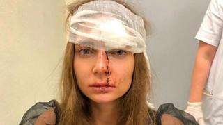 Valentina Sidorova wurde angeblich von einer Schönheits-Ärztin verprügelt.
