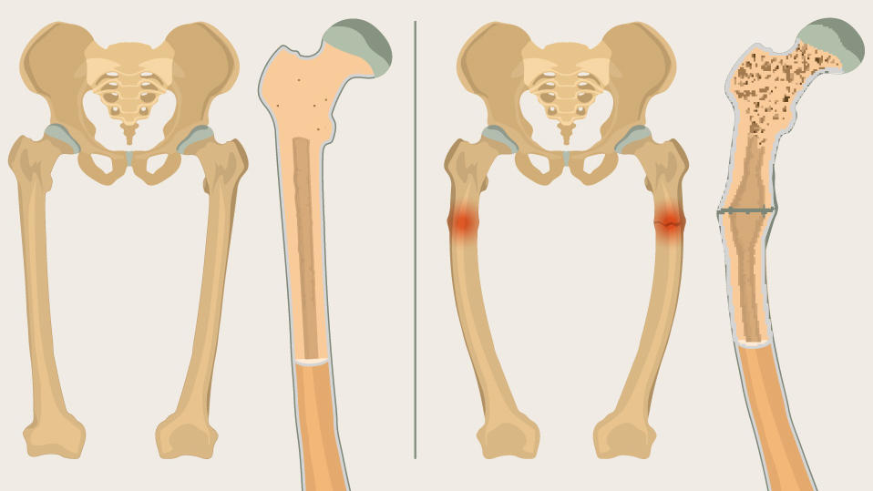 Normale Knochen im Vergleich zu Rachitis und Osteomalazie.