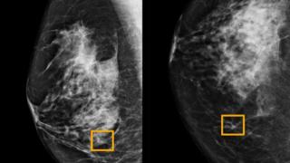 Röntgenbild Brustkrebs