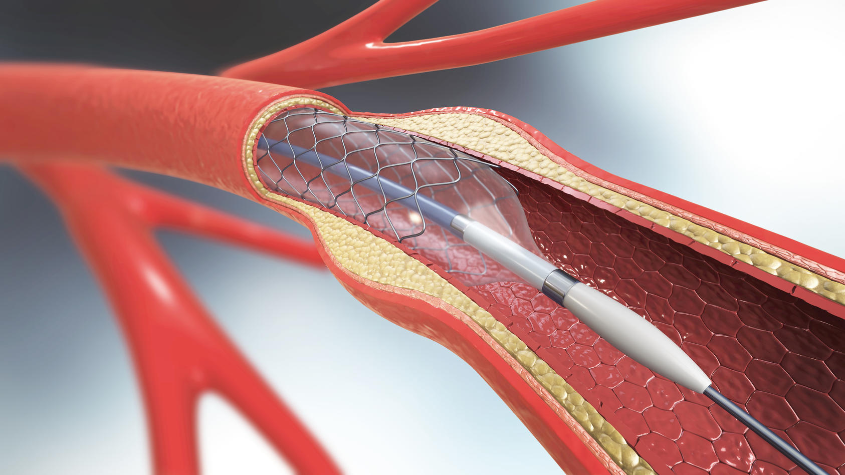 3D-Darstellung der Stent-Implantation zur Unterstützung der Durchblutung in den Gefäßen