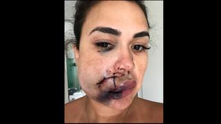 Milka Borges mit schweren Gesichtsverletzungen