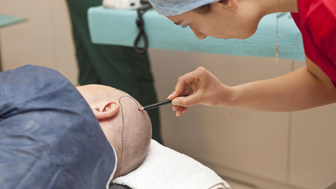 Ein Patient wird für eine Haartransplantation vorbereitet.