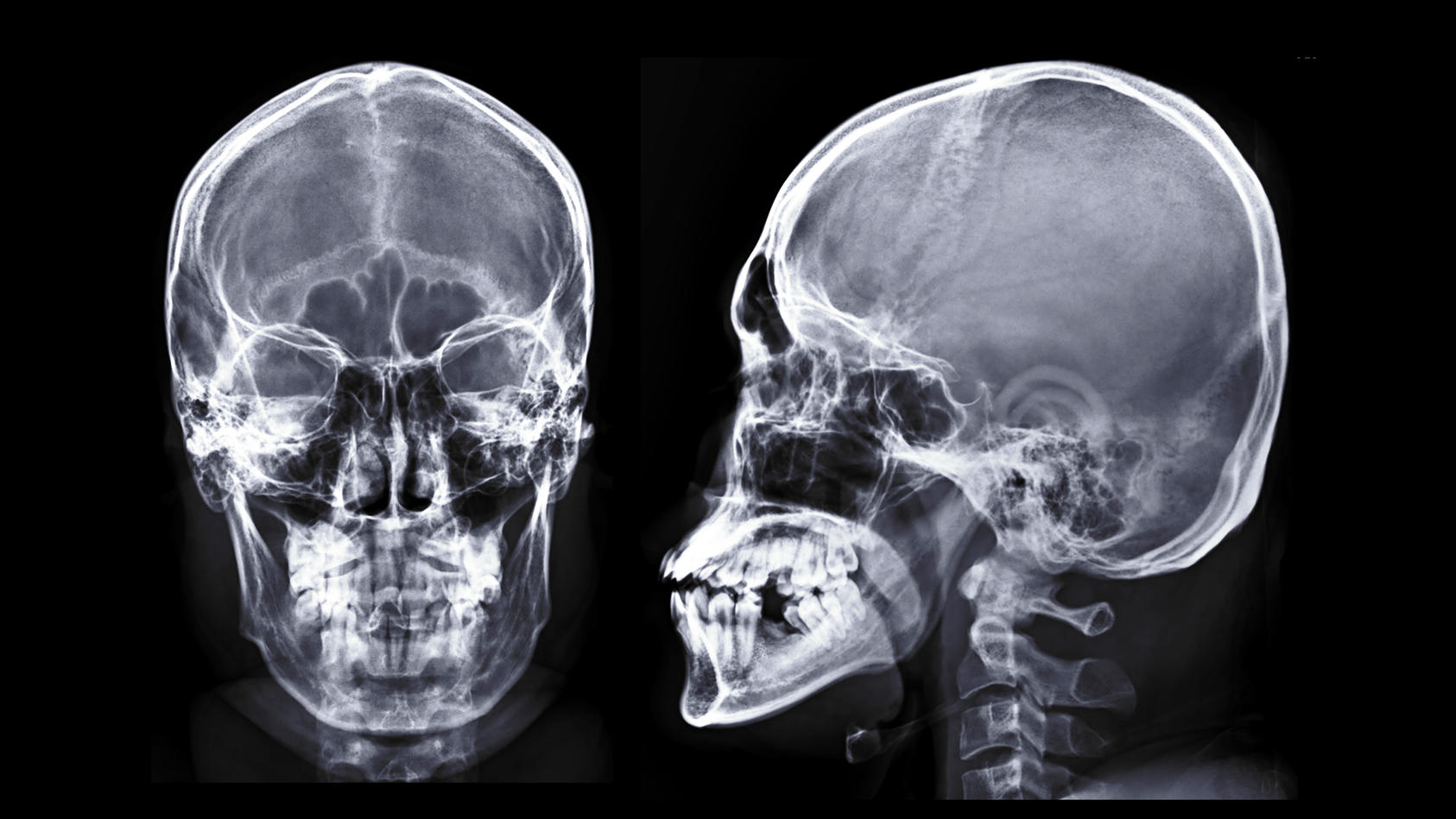 Röntgenbilder eines menschlichen Schädels