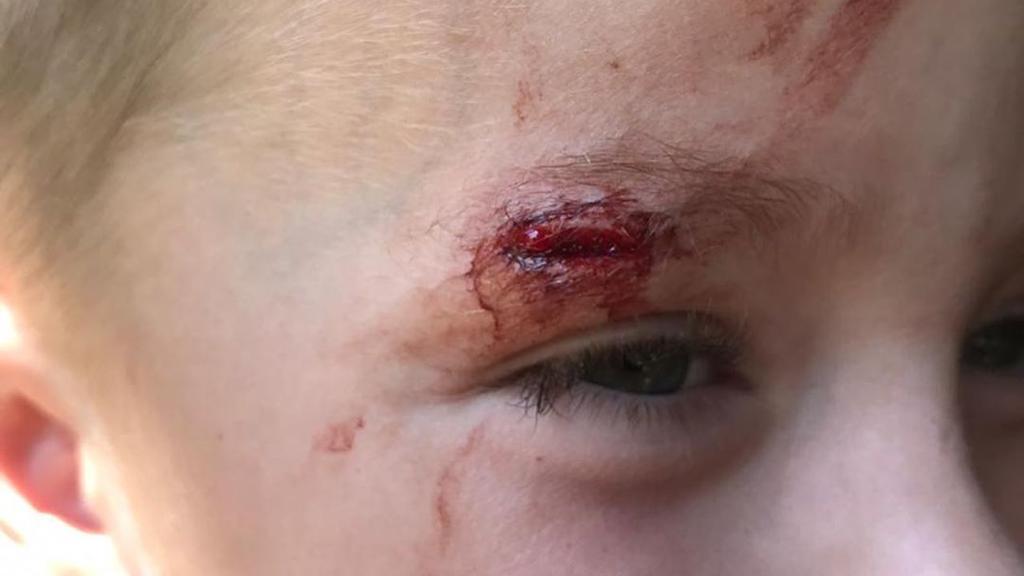 Auf Fotos, die auf Instagram hochgeladen wurden, hatte ein Kind eine gespaltene Augenbraue vom Rückstoß des Gewehrs.