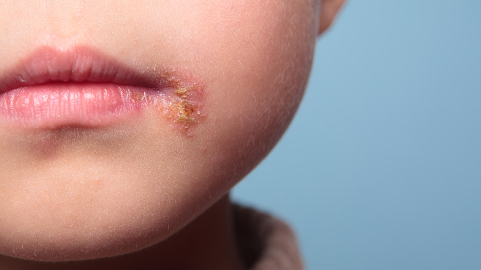 Fieberblaschen Beim Baby Herpes Symptome Beim Kind Erkennen Und Behandeln