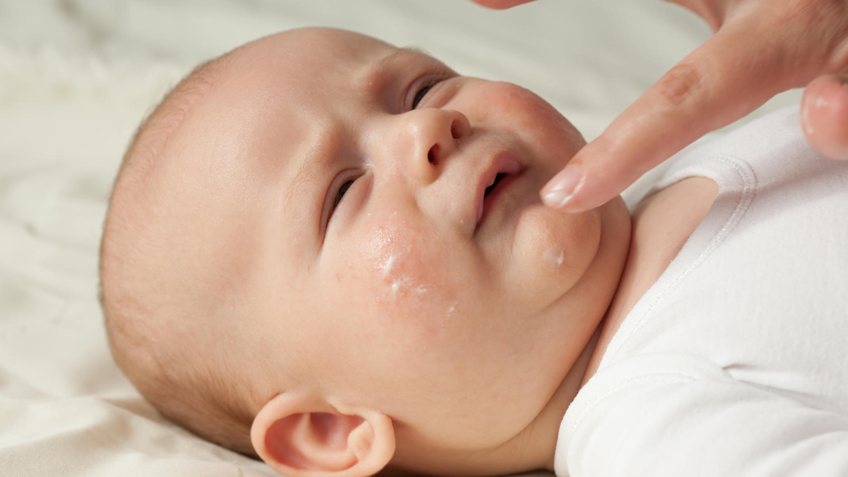 Neurodermitis Baby Was Sie Gegen Ausschlag Und Juckreiz Tun Konnen