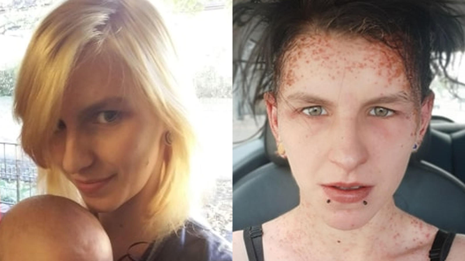 Haarfarbe Aktion Geht Schief 22 Jahrige Erleidet Allergischen Schock Im Gesicht