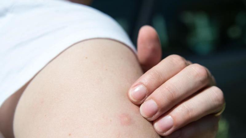 Auch wenn es juckt: An Mückenstichen nicht herumkratzen, sondern sie lieber kühlen. Foto: Andrea Warnecke/dpa-tmn