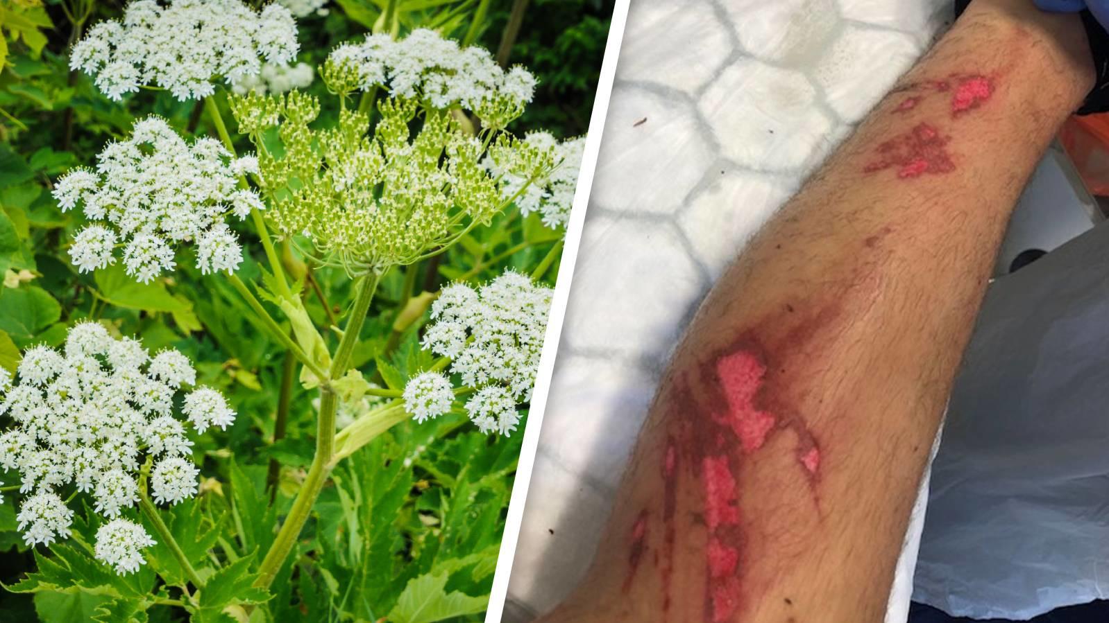 Ein britischer Teenager erlitt schwere Verbrennungen an den Beinen, nachdem er in Kontakt mit Bärenklau gekommen war.