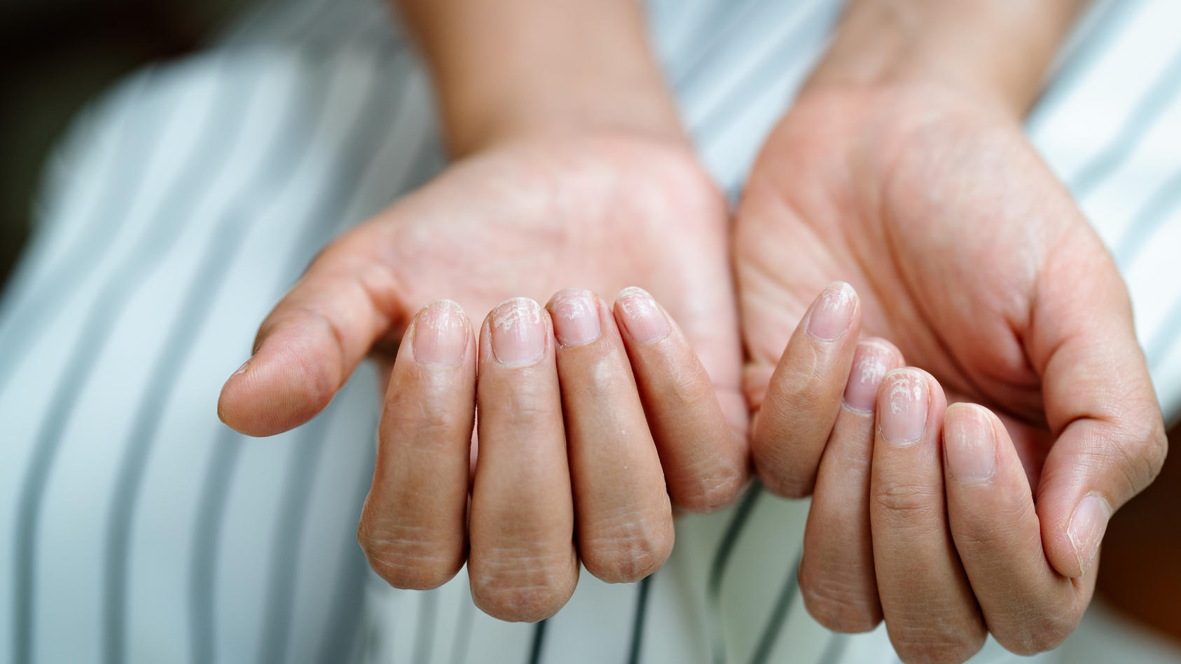 Lungenkrebs An Veranderten Fingernageln Erkennen Diese Nagelform Kann Ein Hinweis Sein Weisse Stiletto Naegel