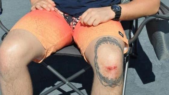 Die einzige Verletzung - ausgerechnet mitten im Hai-Tattoo.