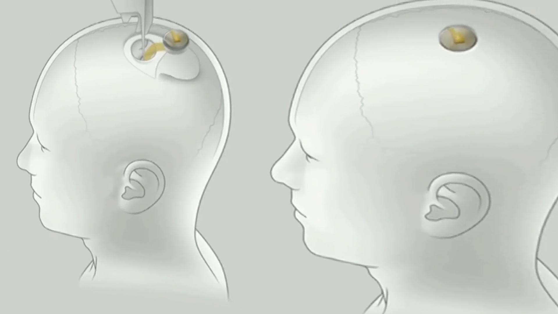 Gehirn-Chip von Neuralink