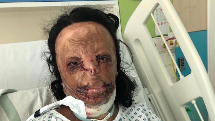 Gesicht von Mädchen ist nach Feuer-Unfall entstellt.