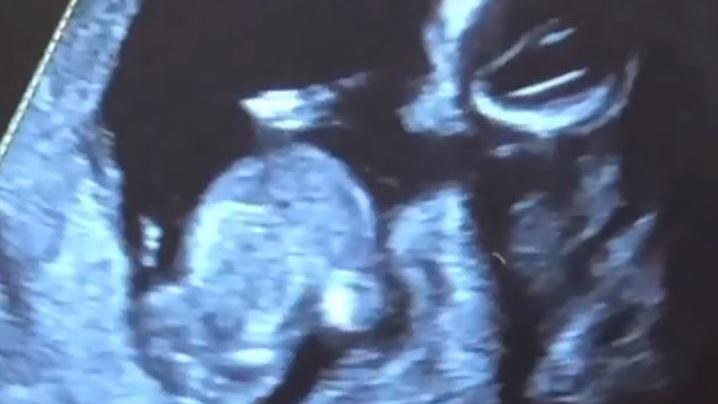 Emily zeigt in ihrer Story ein Ultraschall-Foto.
