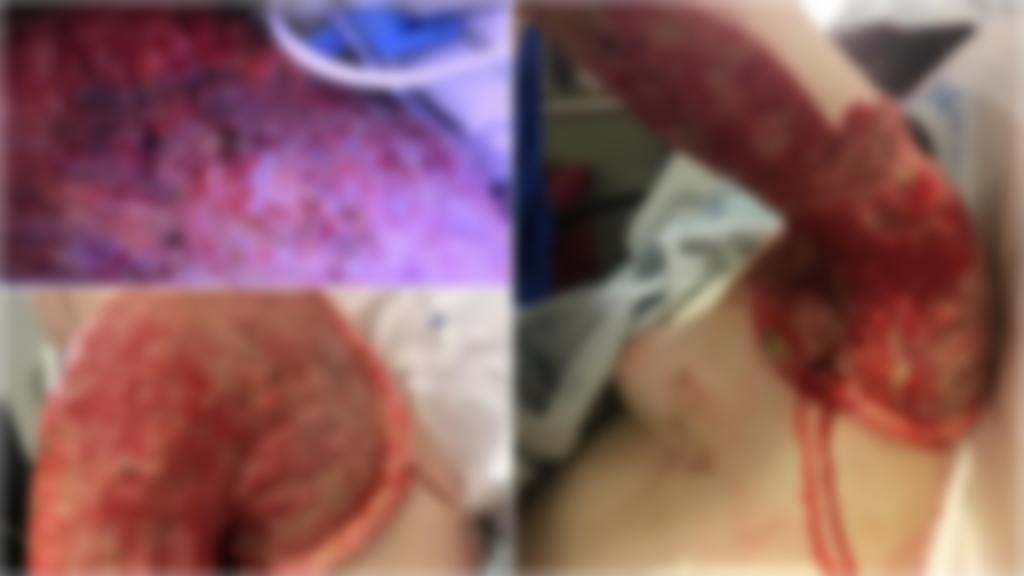 Carolina konnte ihren Arm nur behalten, weil die Ärzte es schafften die infizierten Stücke Fleisch an ihrem Arm zu entfernen.