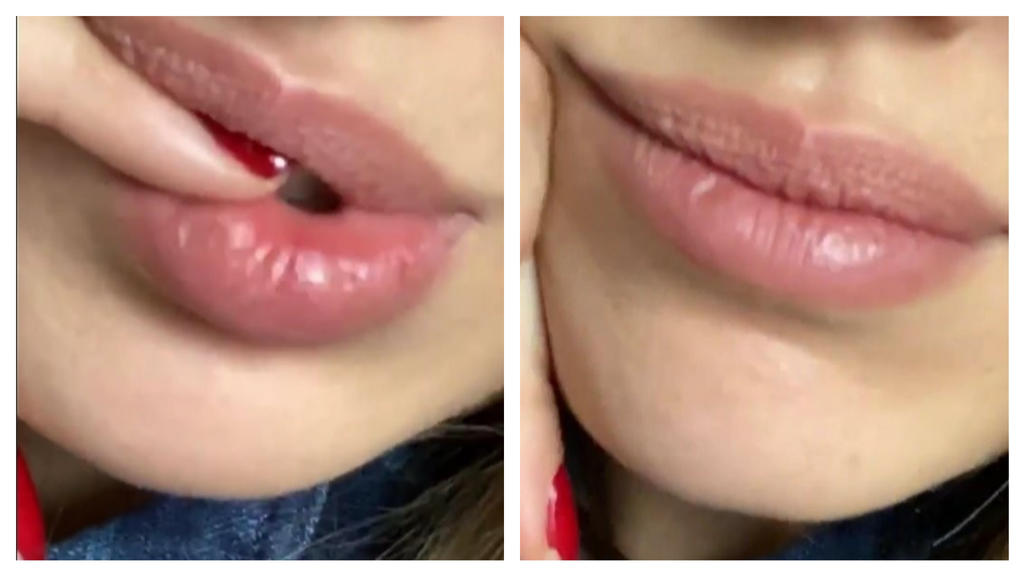 Für diese Lippen musste Nicole Poturalski früher viel einstecken.