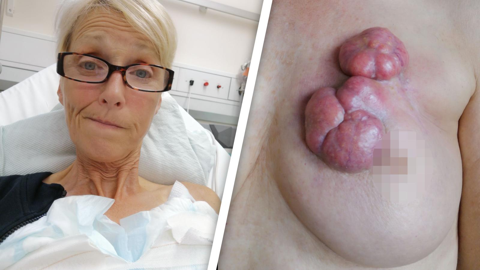 Nina Collins sammelt mit Schockfoto ihrer Tumore Spenden für Behandlung