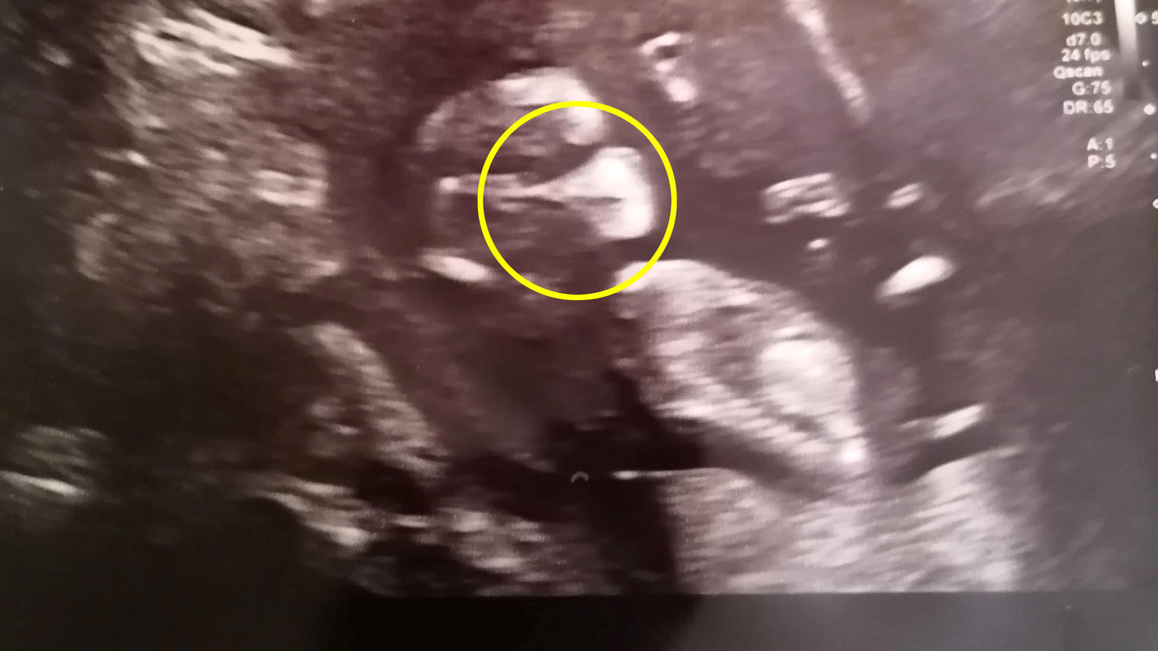 Samantha Spicers Baby scheint auf einem Ultraschallbild eine Maske zu tragen.