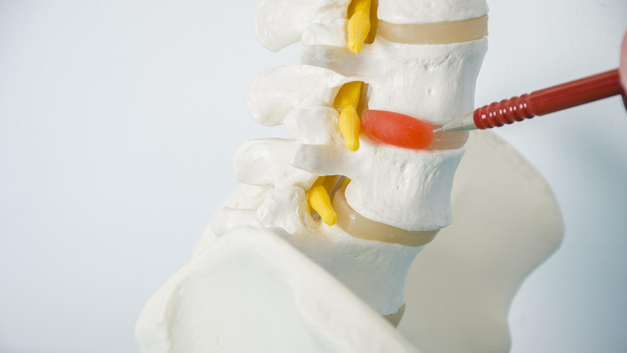 Wirbelkörper (weiß), Bandscheiben (beige) und  Rückenmark (gelb) - bei einem Bandscheibenvorfall tritt Kernsubstanz durch Risse im Faserring aus.