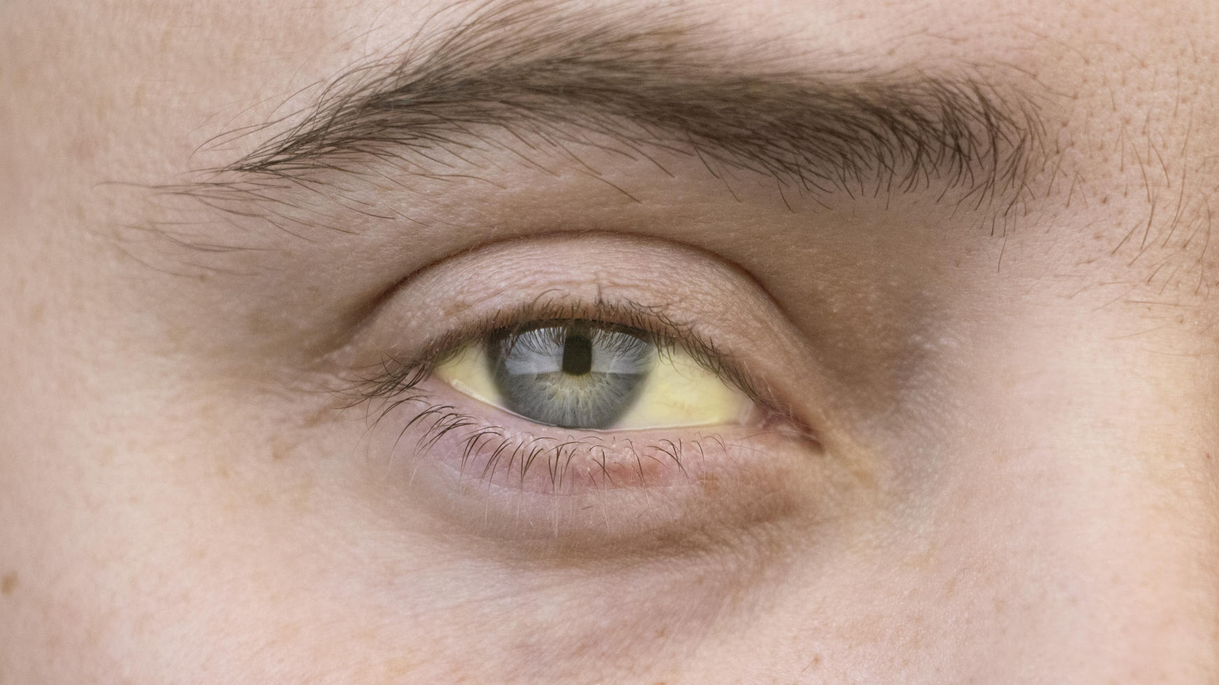 Gelb verfärbte Augen deuten auf eine Lebererkrankung hin.