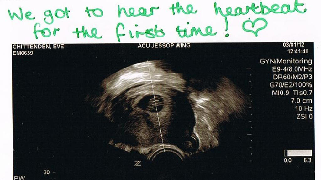 Auf einem Ultraschallbild von Danielle Chittenden aus dem Jahr 2012 sieht man ein Embryo.