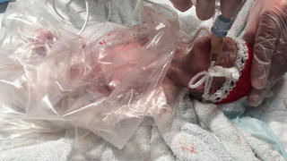 Baby liegt mit einer Plastiktüte umwickelt im Krankenhaus