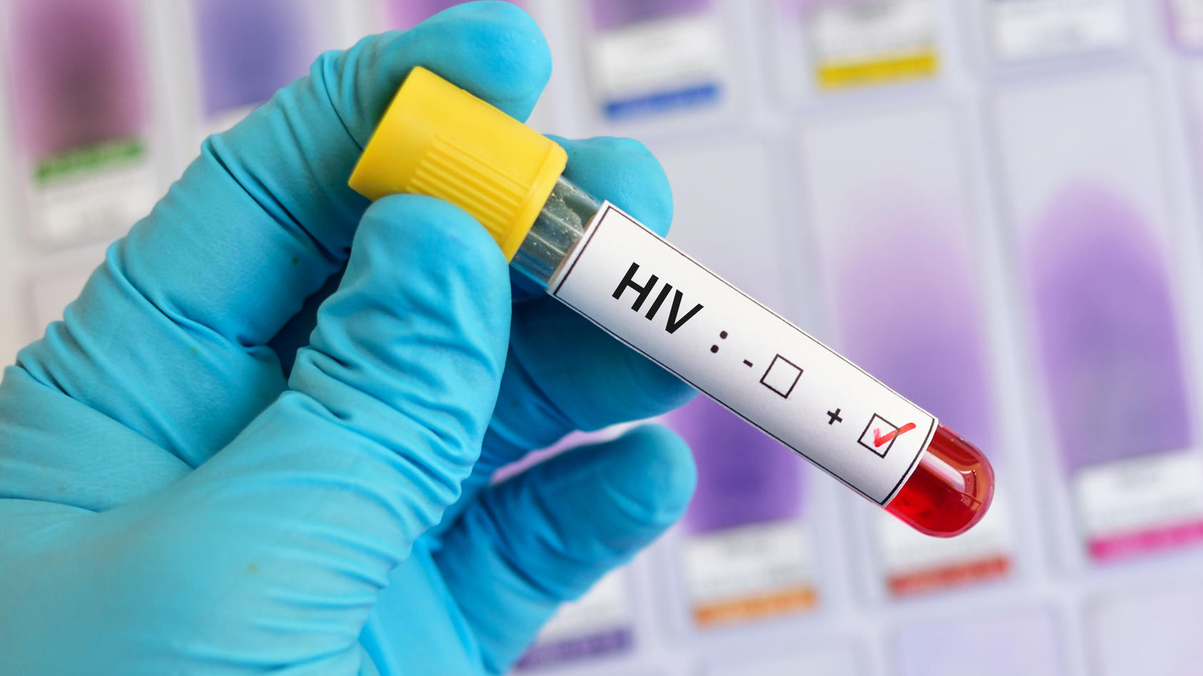 Positiver HIV-Test