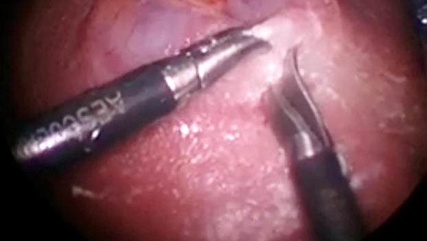 Spina Bifida