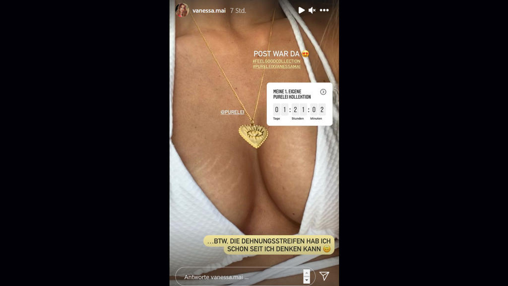 Vanessa Mai macht keinen Hehl daraus, dass ihre Brüste von zarten Rissen bedeckt sind.