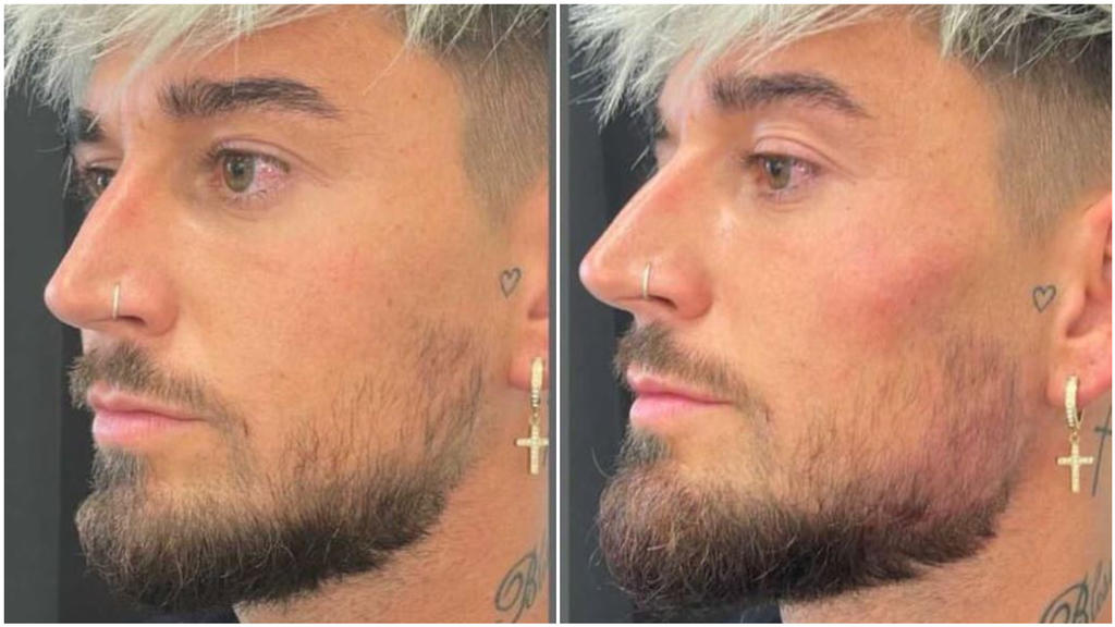 Mike Heiter zeigt sein "neues" Gesicht.