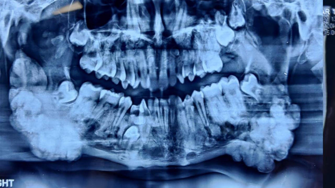 Auf Nitishs Röntgenbild sieht man eindeutig; da sind viel zu viele Zähne in seinem Kiefer.