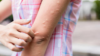 Mückenstiche am Arm einer Frau