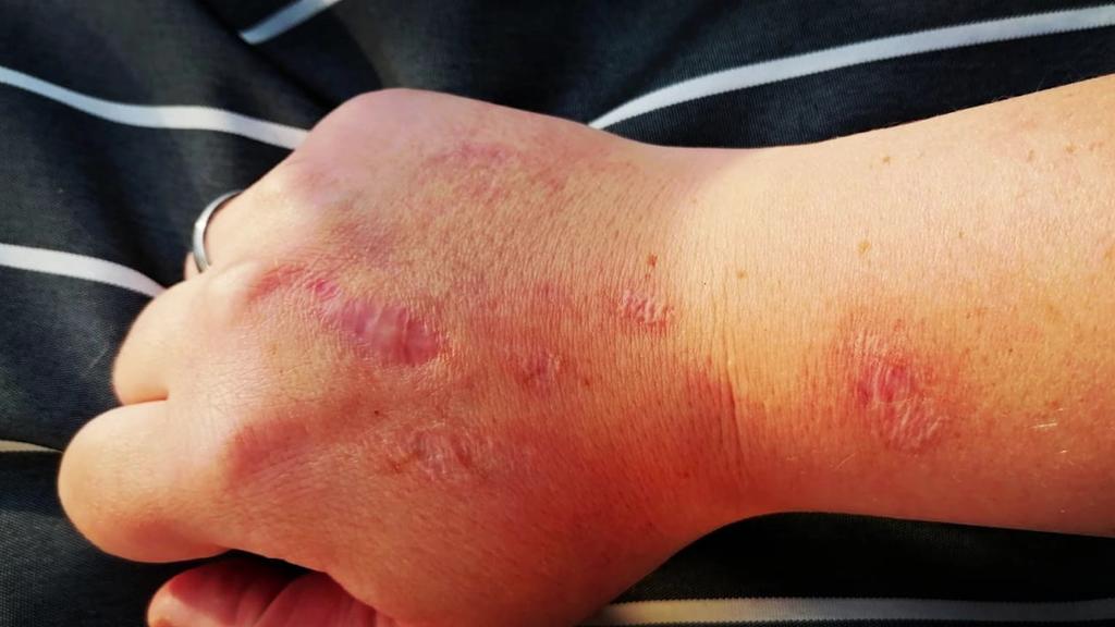 Bärenklau Verbrennungen an Hand