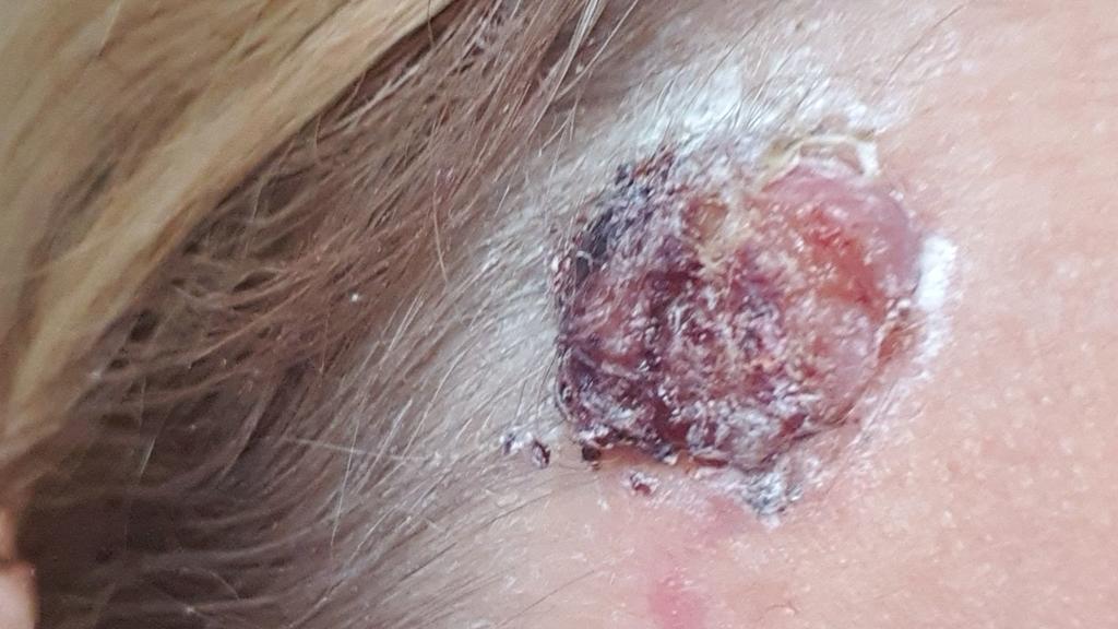 Bösartiger Hautkrebstumor an der Stirn