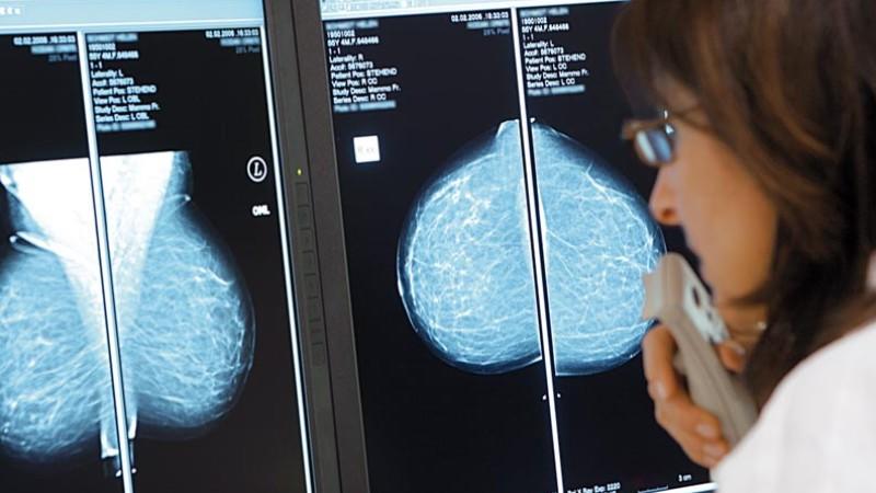 Dank des Mammographie-Screenings hat sich die Früherkennung von Brustkrebs deutlich verbessert.