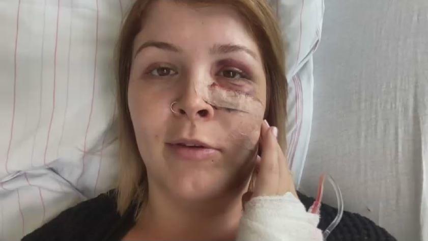 Nach der Operation hat Sarah mehrere Platten im Gesicht, um die gebrochenen Knochen zusammenzuhalten.
