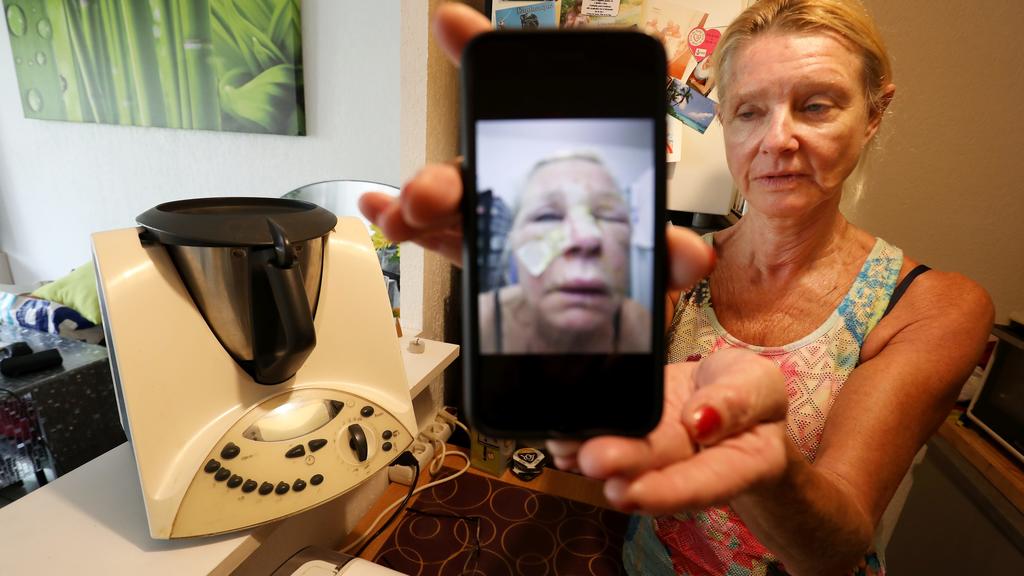 Francia: explosión de Thermomix: una mujer con quemaduras graves en la cara